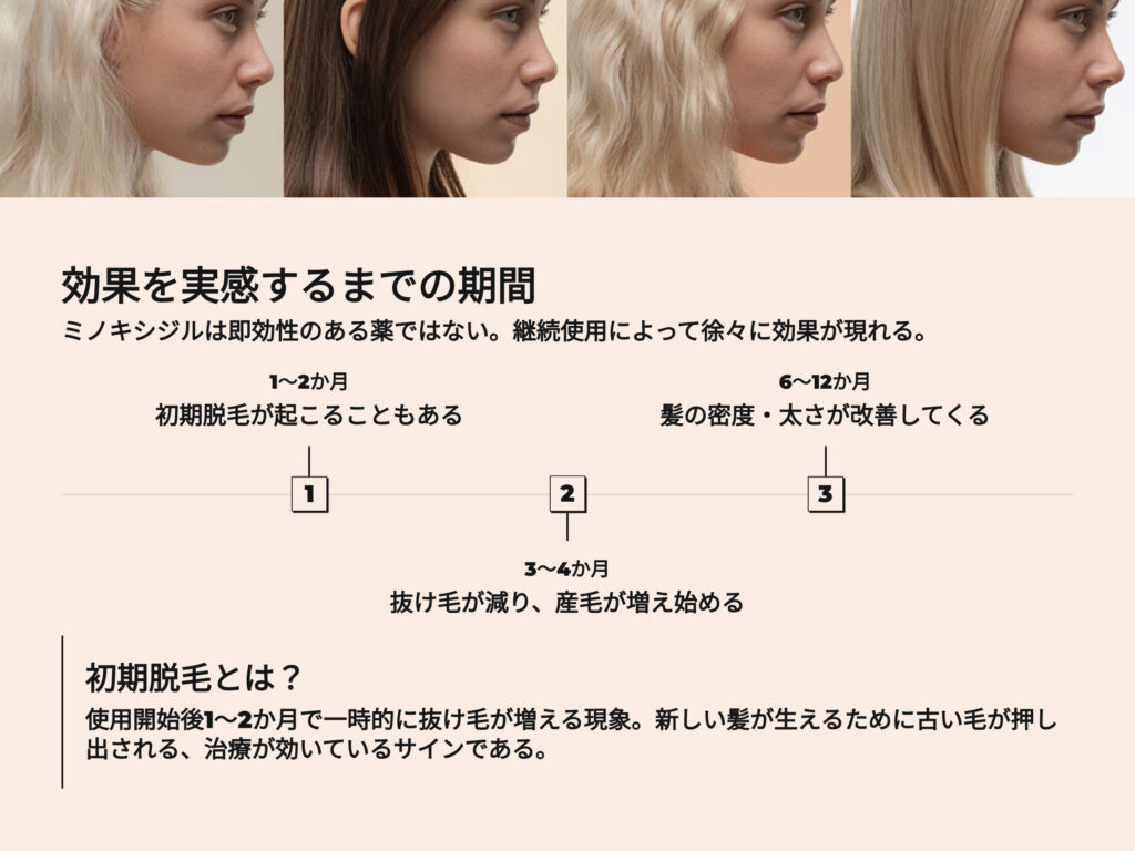 ミノキシジルの効果を実感できるまでの期間
ミノキシジルは即効性のある薬ではない。継続使用によって徐々に効果が現れる
初期脱毛が起こることもある
髪の密度太さが改善してくる
抜け毛が減り、産毛が増え始める
初期脱毛とは?
使用開始後1~2か月で一時的に抜け毛が増える現象。新しい髪が生えるために古い毛が押し出される。治療が効いているサインでもある。