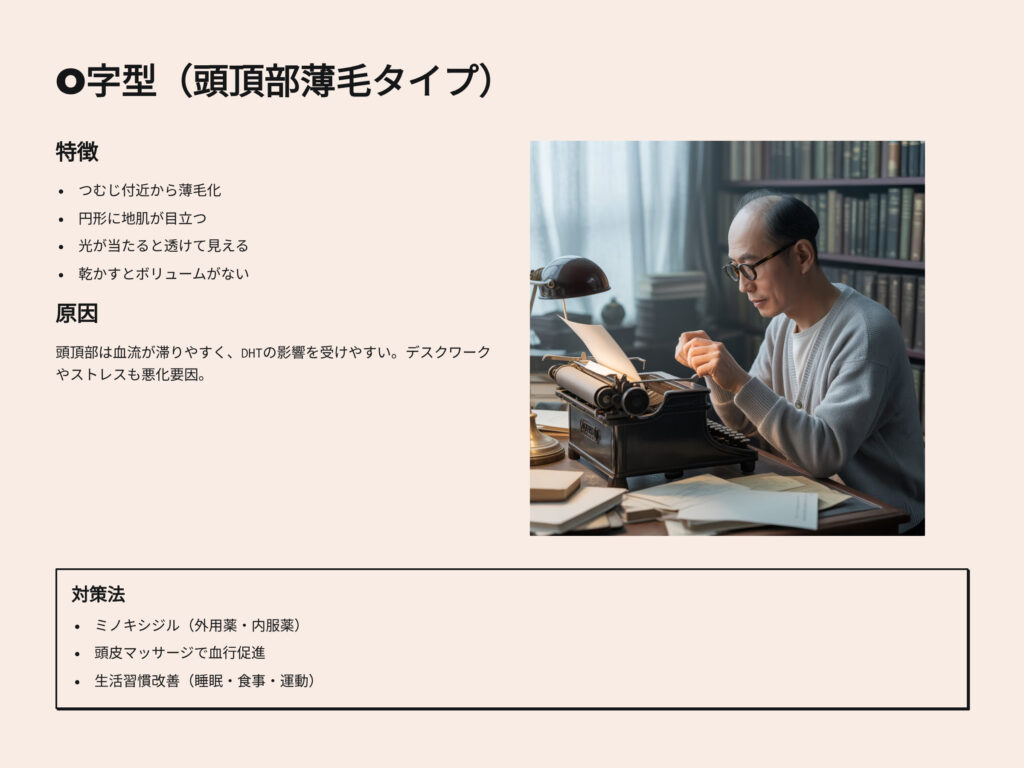 O字型ハゲ（頭頂部薄毛タイプ）
特徴
つむじ付近から薄毛化
円形に地肌が目立つ
光が当たると透けて見える
乾かすとボリュームが無い
O字型ハゲの原因
頭頂部は血流が滞りやすく、DHTの影響を受けやすい
デスクワークやストレスも悪化要因
O字型ハゲの対策法
ミノキシジル（外用薬、内服薬）
頭皮マッサージで血流促進
生活習慣改善　睡眠、食事、運動